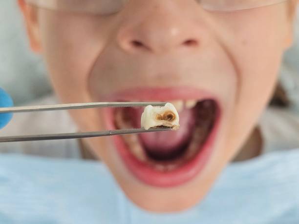 Best Emergency Treatment for Dental Infections or Abscesses in Minonk, IL